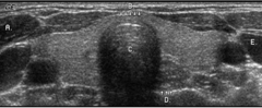 <p>Identify the structure labeled E</p><p>a. common carotid artery</p><p>b. internal jugular vein</p><p>c. external jugular vein</p><p>d. longus coli muscle</p><p>e. subclavian vein</p>
