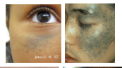 <p>What is the most likely diagnosis ?</p>