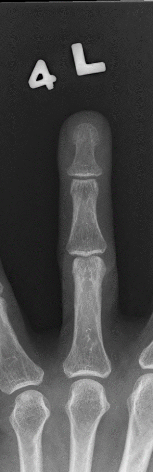 <p>What projection is this finger x-ray?</p>