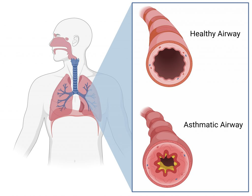 <p>A chronic condition in which the airways become inflamed and narrowed, causing difficulty in breathing.</p>