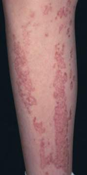 <p>streaks along the lines of Blaschko</p><p>Arises early in life and is associated with higher risk of SCC</p>