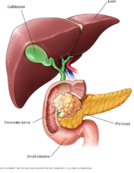 <p>Protein hormone secreted by the alpha cells of the pancreas that <strong>Increases blood glucose</strong> through glycogenolysis and gluconeogenesis in the liver</p><p>A minor target organ for glucagon is adipose tissue; glucagon increase lipolysis and enhances ketogenesis</p><p>Levels are regulated by plasma glucose concentrations; levels become increased during stress and exercise and in hypoglycemic episodes</p><p>Long term diabetes mellitus leads to an impaired glucagon response to hypoglycemia</p><p>Extremely high levels of glucagon are seen in patients with glucagonomas: tumors in the alpha cells of the pancreas</p>