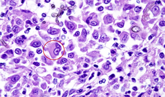 <p>epithelioid macrophage</p>