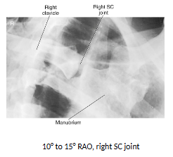 <ul><li><p>Both obliques are done for comparison</p></li><li><p>Manubrium</p></li><li><p>Medial portion of clavicles</p></li><li><p><strong>Downside SC joint is best demoed</strong></p></li><li><p>SC joint on the upside will be foreshortened</p></li></ul><p></p>