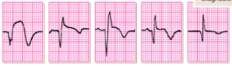 <p>what does this EKG show? </p>
