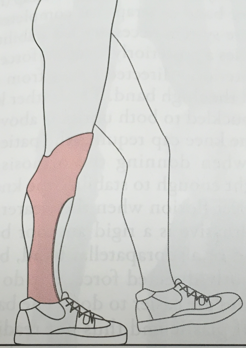 <p><span>Option C is correct. It is a floor reaction orthosis that controls knee instability. Options A and B are KAFOs. Option B is a KAFO with a frontal plane control specifically for genu valgum.&nbsp;&nbsp;With these KAFOs, the patient will be less compliant using these braces because they are more difficult to don and doff and more invasive. Option D is an infrapatellar strap, which would not control knee instability.</span></p>