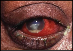 <p>pus in the anterior chamber of the eye</p>
