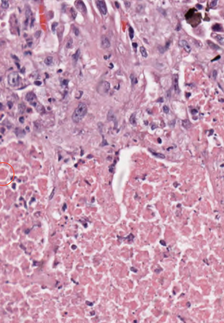 <p><span>What types of necrosis are shown in this picture? What are the clinical features of this type of necrosis? </span></p>