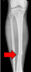 <p>What fracture is this?</p>