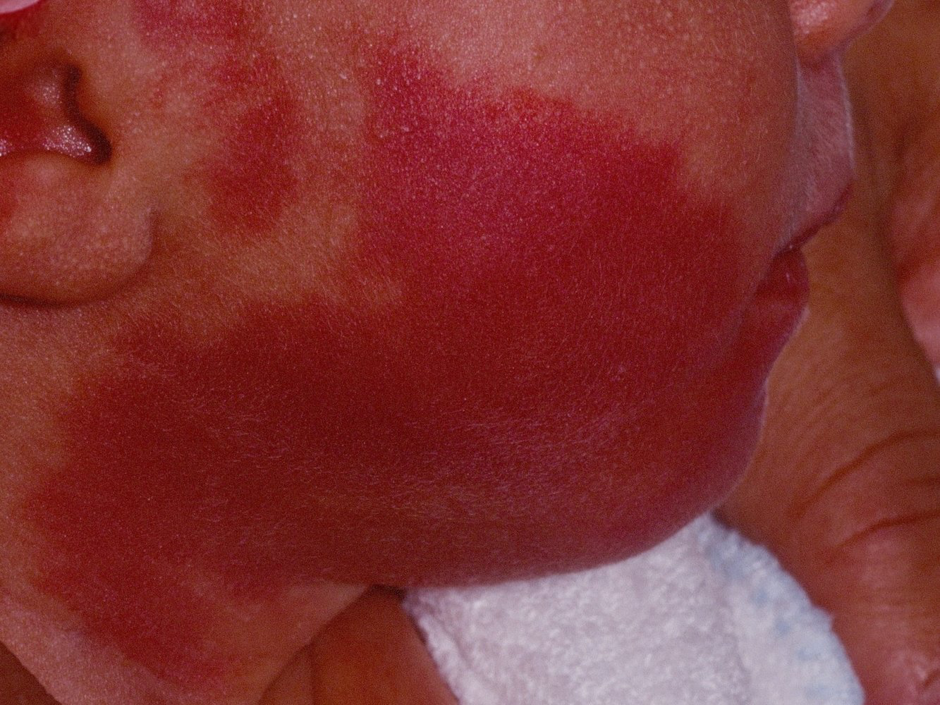 <p>A type of capillary malformation, also known as a port-wine stain, present at birth and distinguished by its flat, pink to red appearance that can grow and thicken overtime </p>
