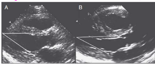 <p>The aortic valve is unwedged and displaced anteriorly. This lengthens the LV outflow tract and produces the <strong>gooseneck appearance</strong>.</p><p>(views PLAX, LVOT, A5C) (pic A is normal, B <strong>gooseneck appearance</strong>.</p>