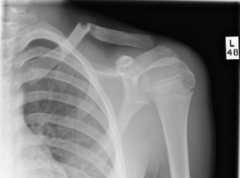 <p>clavicle:</p><p>- deformity</p><p>- swelling</p><p>- tenderness</p><p>- crepitus</p>
