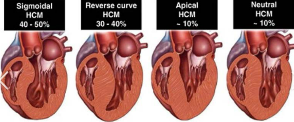 <p>Disproportionate/abnormal hypertrophy of the LV and RV •</p><p> Diastolic Dysfunction • </p><p>Can be obstructive or non obstructive • </p><p>Idiopathic hypertrophic subaortic stenosis via muscular subaortic stenosis</p>