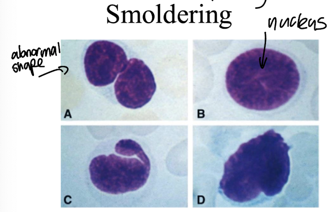 <p><strong>T cells appear with a <mark data-color="purple" style="background-color: purple; color: inherit;">large nucleus-to-cytoplasm ratio, </mark>minimal cytoplasm, and are often irregularly shaped. </strong></p><ul><li><p><strong>These cells exhibit mild atypia but maintain their overall cellular integrity. </strong></p></li></ul><p></p>