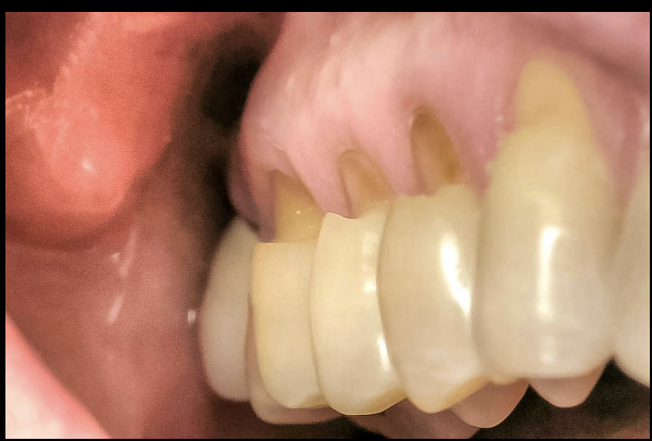 <p>v-shaped loss of hard tooth structure cause by biomechanical loading forces from flexure and/or chemical degradation of enamel and/or dentin at same location distance from the actual point of laoding </p>
