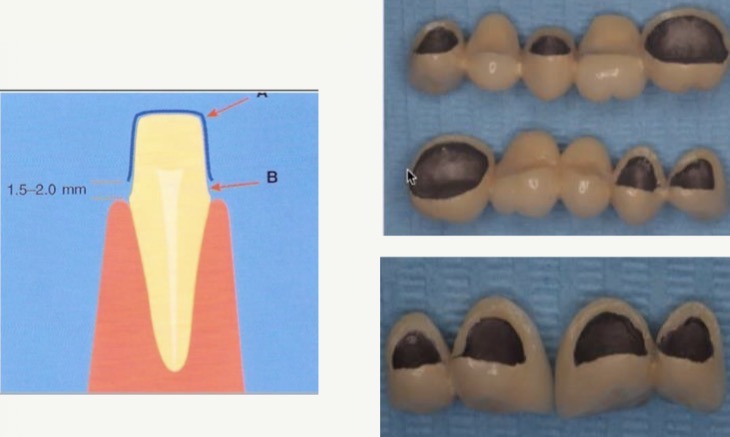 <p>Consist of bridges with a metal structure where the covering of the same on the abutment tooth ends</p><p>1.5-2mm from the chamfer, giving a more translucent porcelain margin, increasing light diffusion to the soft tissue</p><p>Greatly avoids the umbrella effect</p><p>The reduced structure does not decrease the mechanical resistance</p><p>In longer stretches with aesthetic commitment</p><p>Can be used in cases of cast metal post and core.</p><p>Shoulder ceramics with a higher melting temperature than conventional ones on metal are used</p><p>For cementing, use adhesive techniques and silanization</p>