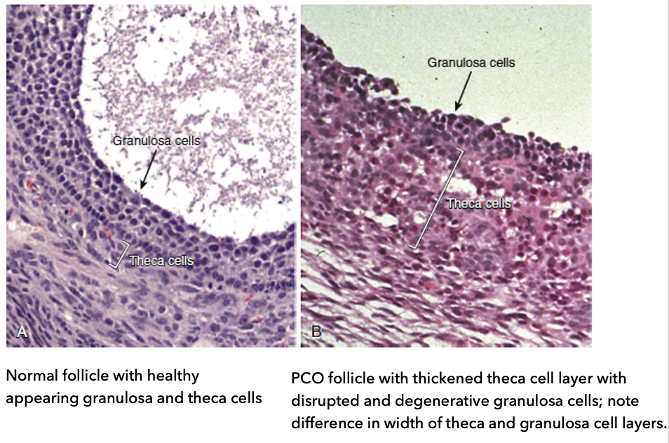 <ul><li><p><strong>A: Normal follicle:</strong></p><ul><li><p><strong>Healthy granulosa cells</strong> (supporting cells around oocyte)</p></li><li><p><strong>Healthy theca cells</strong> (hormone-producing layer)</p></li><li><p>Balanced <strong>width of granulosa and theca layers</strong></p></li></ul></li><li><p><strong>B: PCOS follicle:</strong></p><ul><li><p><strong>Thickened theca cell layer</strong> (more cells → possible ↑ androgen production)</p></li><li><p><strong>Disrupted and degenerative granulosa cells</strong></p></li><li><p><strong>Altered layer widths</strong> compared to normal</p></li></ul></li><li><p><strong>Key idea:</strong></p><ul><li><p>Histology shows <strong>follicle dysfunction + hyperactive theca cells</strong>, contributing to PCOS pathology</p></li><li><p><em>Hypothesis: Perhaps hyperandrogenism is coming from the ovaries</em></p></li></ul></li></ul><p></p><p>*<em>*Thecal cell = general term (thecal cells in adrenal gland); Theca = cells in the ovaries </em></p>
