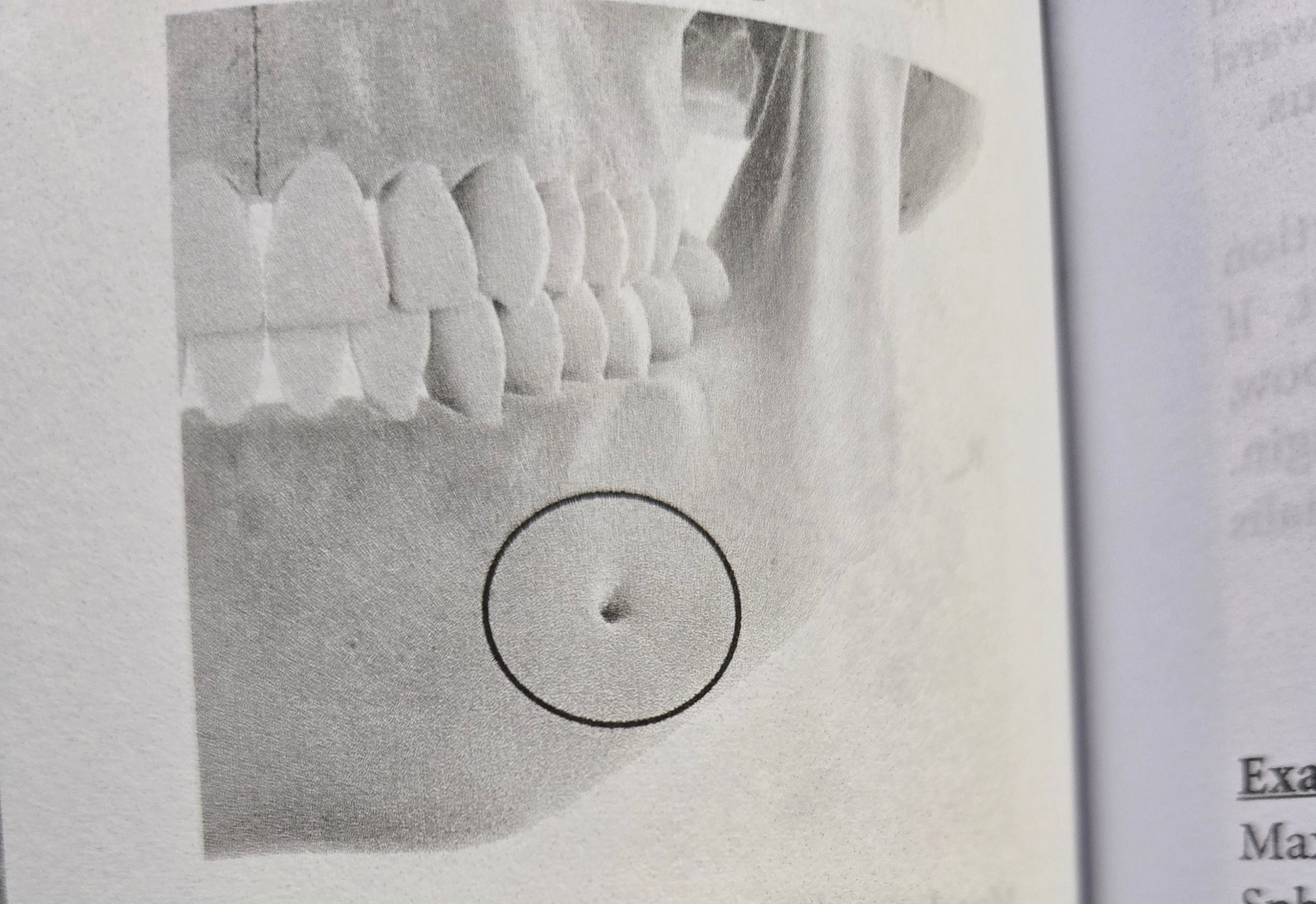 <p>Foramen</p>