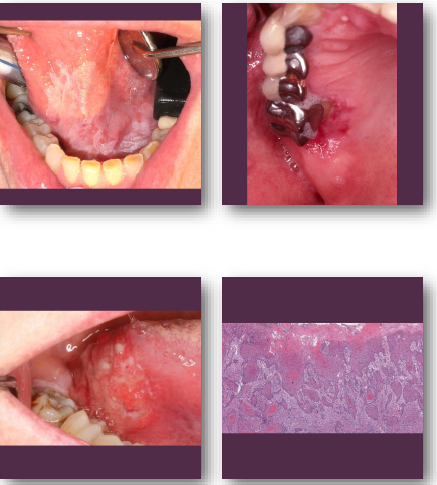 <p>•<strong>Non-healing ulcer or exophytic mass lesion</strong></p><p>•Mixed<strong> red and white mucosal appearance</strong></p><p>•<strong>Induration on palpation</strong> is key finding</p><p>•Common on tongue and floor of mouth</p><p>•May be painless early and painful later</p>