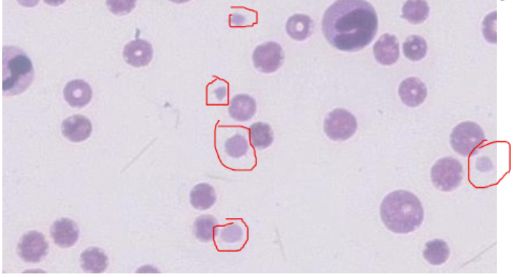 <p>Thrombocytopenia</p>
