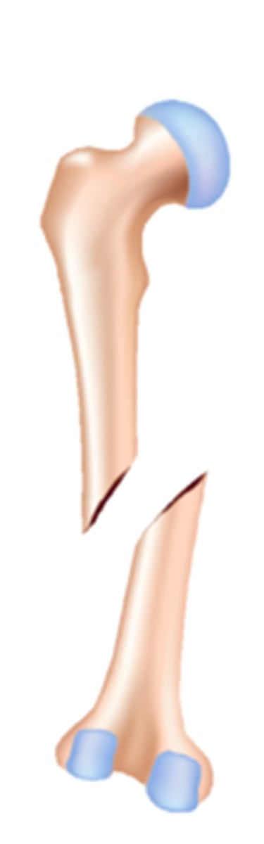 <p>a bone fracture that causes the bones to misaligned</p>