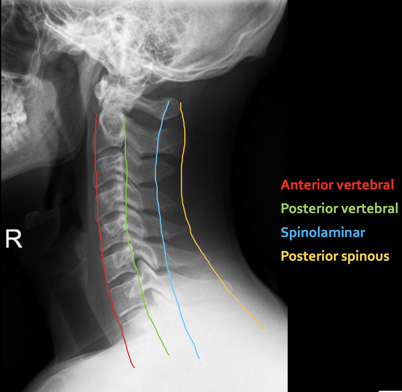 <p><strong>Posterior spinous</strong></p>