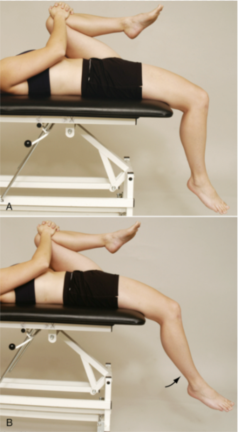 <p><strong>Purpose:</strong> <span style="color: red;"><strong>Rectus femoris contracture or tightness - MLT</strong></span></p><p><br><strong>How to Perform:</strong></p><ol><li><p>Pt supine with knees bent over edge of table</p></li><li><p>Pt flexes non-test knee to chest and holds while test leg hangs over the table</p></li><li><p>Examiner observes whether test knee stays at 90°</p></li><li><p>Examiner may passively flex knee to 90° and see if it remains there</p></li><li><p>Palpate for muscle tightness and compare sides</p></li></ol><p><br><strong>Positive Test:</strong> </p><ul><li><p><span style="color: red;"><strong>Test knee does not remain at 90° and extends slightly when non-test hip/knee is flexed to chest</strong></span></p></li><li><p>Muscle stretch end-feel and palpable tightness support rectus femoris restriction</p></li></ul><p><br><strong>Interpretation: </strong>No palpable tightness or a firm/capsular end-feel suggests joint/capsular restriction instead of muscular restriction</p>