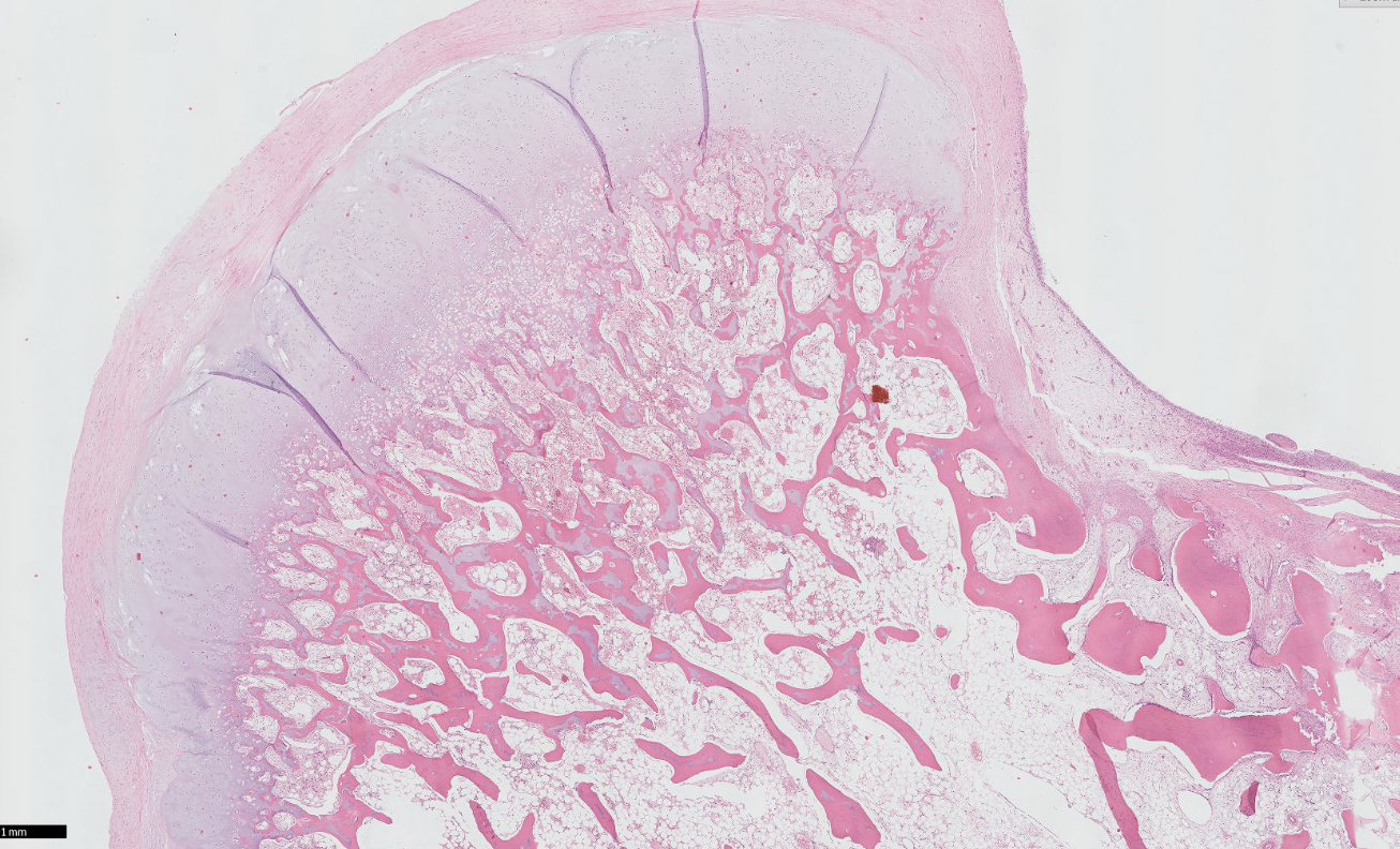<p>Tumeur tibia proximal garçon de 10 ans </p><p>1) diagnostic</p><p>2) localisations </p><p>3) morphologie</p><p>4) moléculaire</p><p>5) DD et arguments </p>