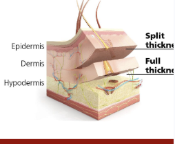 <ol><li><p>developed by james barrett brown </p><ol><li><p>it is a skin graft invoving the epidermis and portion of the dermous</p><ol><li><p>thicker than previous grafts only including the pideris</p></li><li><p>first successfull skin graft between identical twins (syngenic)</p></li></ol></li></ol></li></ol><p></p>