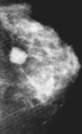 <ul><li><p>Fluid filled sac </p></li><li><p>Painful and affected by menstrual cycle </p></li><li><p>Can be aspirated </p></li><li><p>Better seen on US - determine nature of cyst </p></li></ul><p></p>