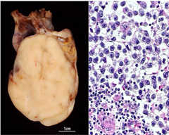 <p>-most common: germ cell tumors</p><p>-most common tumor of young men (15-34)</p><p>2 Groups:</p><p>1. Seminomatous tumors (resemble germ cells)</p><p>-remain localized</p><p>-most common</p><p>2. Nonseminomatous tumors (resemble stem cells)</p><p>-more aggressive</p>