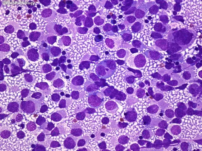 <p>Tumeur du médiastin </p>