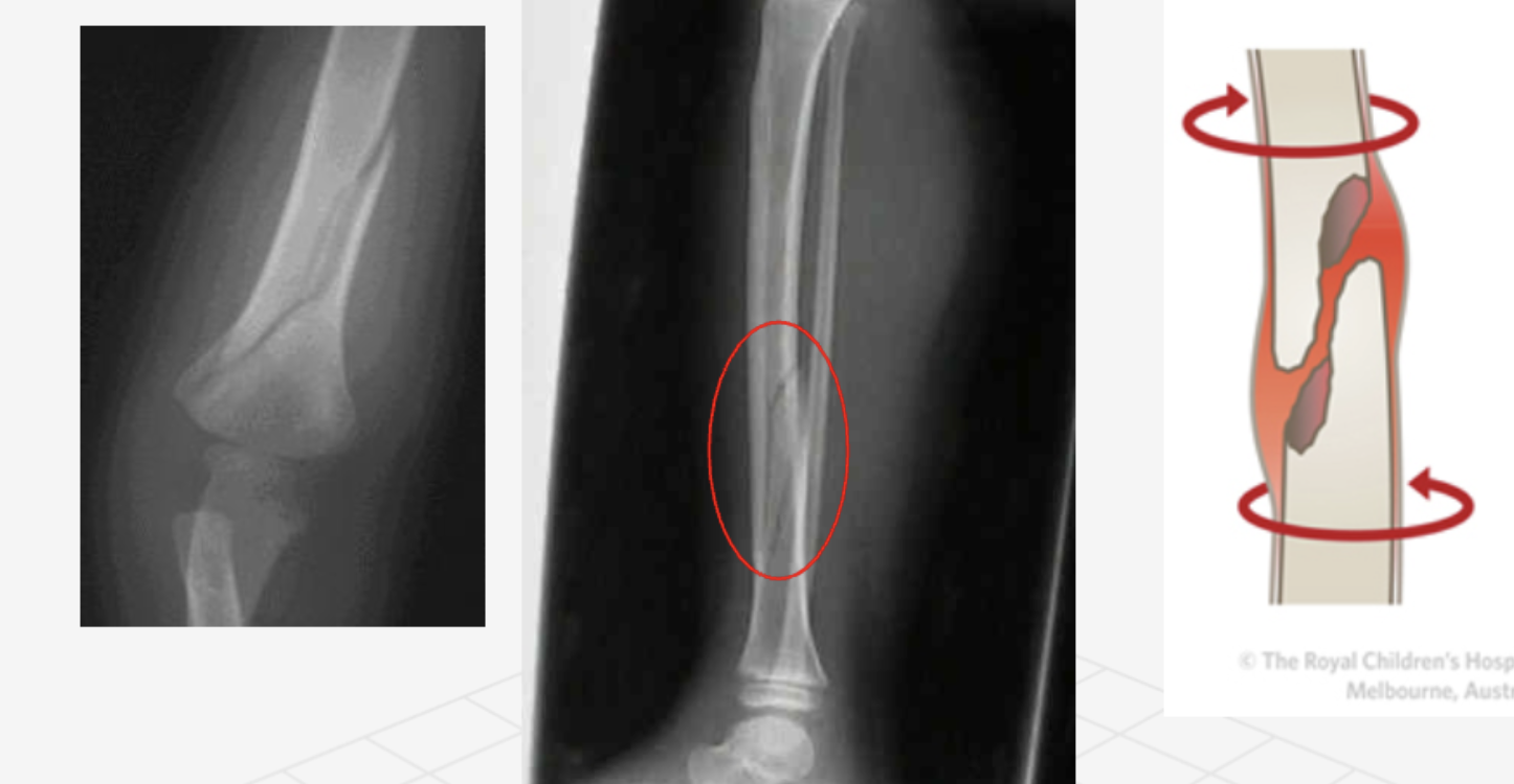 <p>what type of fracture</p>