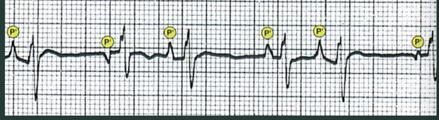 <p>What are the traits of a wandering atrial pacemaker (WAP)? </p>