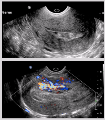<ul><li><p><span style="background-color: transparent;">Partial evacuation of products of conception (POC)</span></p></li><li><p><span style="background-color: transparent;">Clinical signs:</span></p><ul><li><p><span style="background-color: transparent;">Slow fall or plateauing of HCG levels</span></p></li><li><p><span style="background-color: transparent;">Moderate cramping</span></p></li><li><p><span style="background-color: transparent;">Persistent, heavy bleeding</span></p></li></ul></li><li><p>US findings:</p><ul><li><p><span style="background-color: transparent;">Presence of complex collection of echoes in endometrium of retained products of conception (RPOC)</span></p><ul><li><p><span style="background-color: transparent;">Air bubbles</span></p></li><li><p><span style="background-color: transparent;">Retained bony fragments</span></p></li></ul></li><li><p><span style="background-color: transparent;">Hematoma&nbsp;</span></p></li><li><p><span style="background-color: transparent;">Persistence of trophoblastic waveforms near EC 5 days post abortion</span></p></li></ul></li></ul><p></p>
