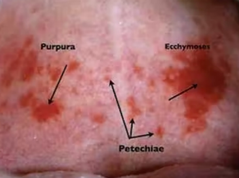 <p>purpura → 4mm, 10mm</p><p>ecchymosis → larger than 1cm</p><p>petechiae → pinpoint, less than 4mm</p>