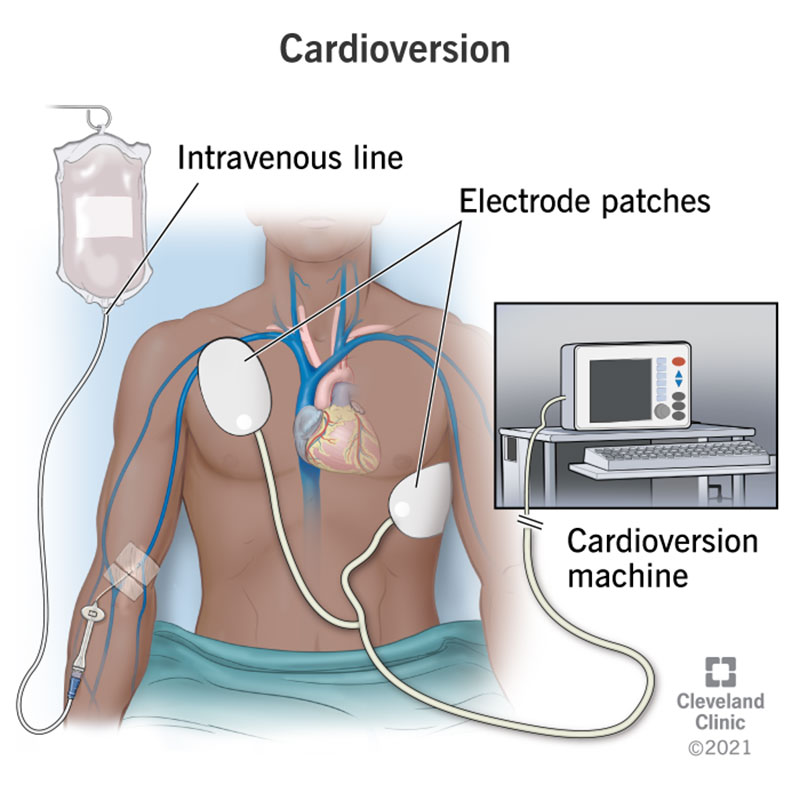 <p>Cardioversión</p>