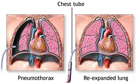 <p>What does a chest tube do?</p>
