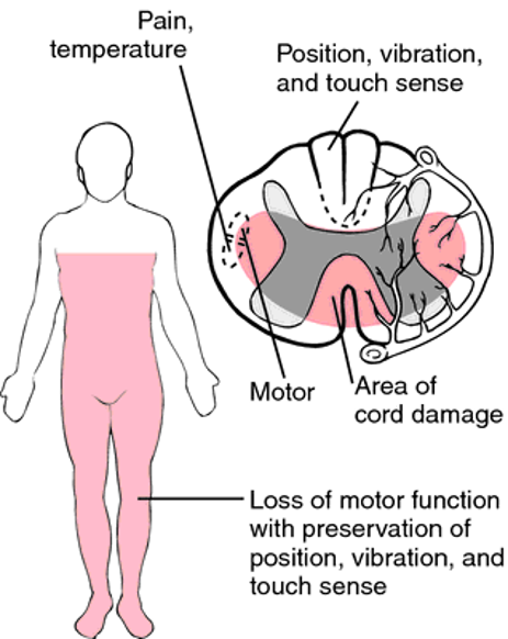 <ul><li><p>Incomplete</p></li><li><p>Injury to the anterior cord</p></li><li><p>Loss of voluntary motor, pain, and temperature perception below the injury</p></li><li><p>Retains posterior column function (sensations of touch, position, vibration, motion)</p></li></ul><p></p>