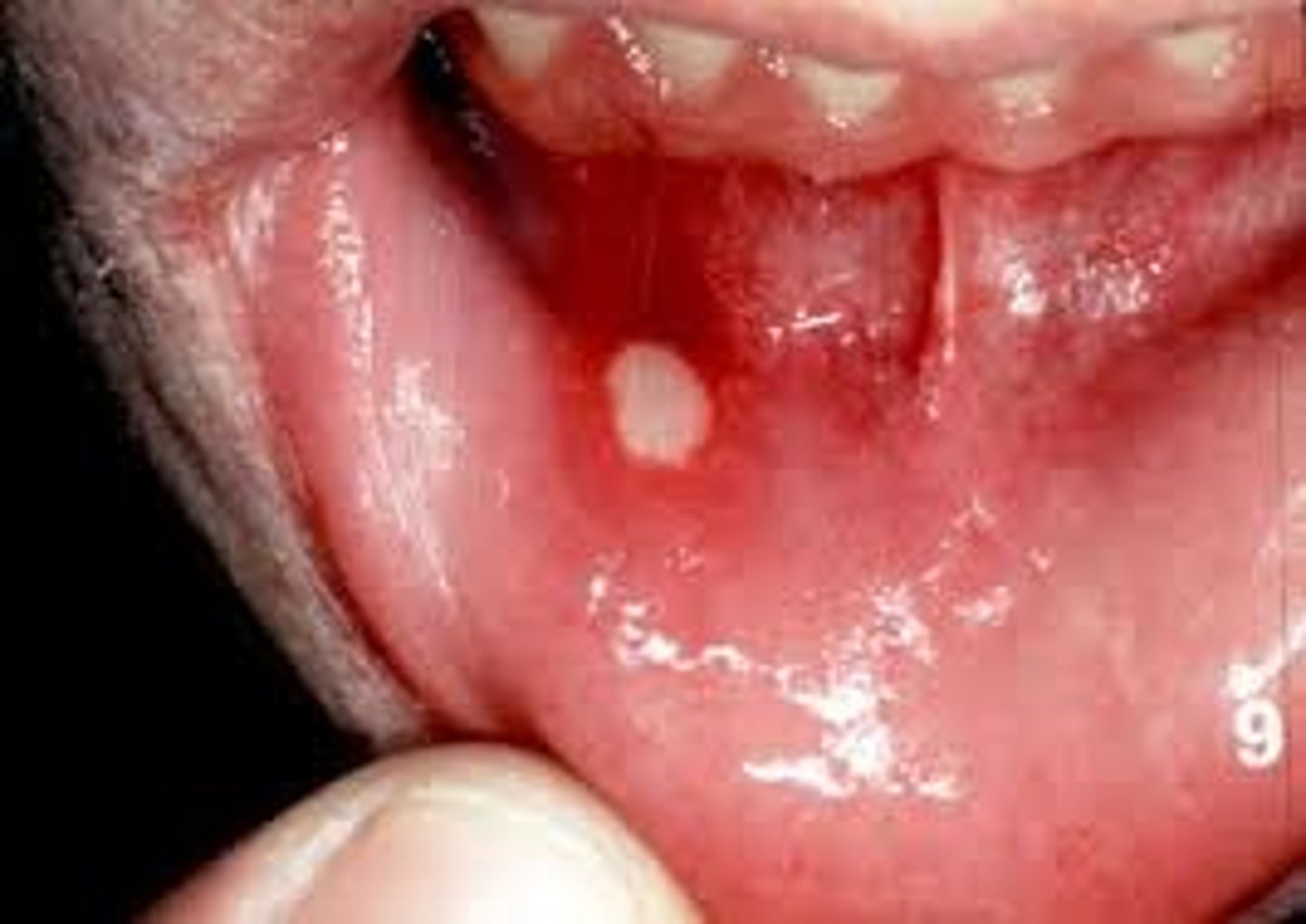<p>stomatitis</p>