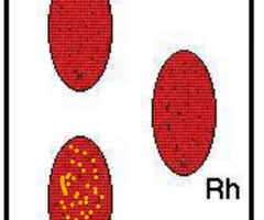 <p>What is the blood type indicated by the results in the right tray?</p>