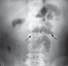 <p>-presents with sudden bilious vomiting, abdominal distention</p>