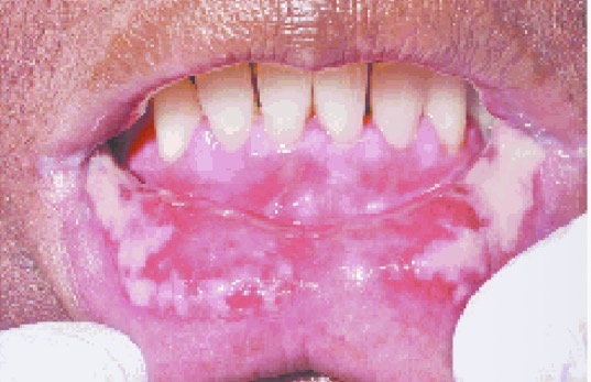 <p>BN CÓ VẾT LOÉT, ĐỎ, ĐAU </p><p>CHẨN ĐOÁN</p>