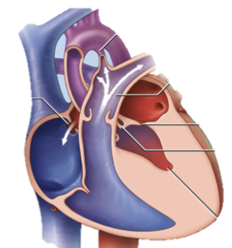 <ul><li><p>small underdeveloped LV w/ poor contractility</p></li><li><p>may be caused by:</p><ul><li><p>Ao atresia</p></li><li><p>Ao hypoplasia</p></li><li><p>severe AS</p></li></ul></li></ul><p></p>