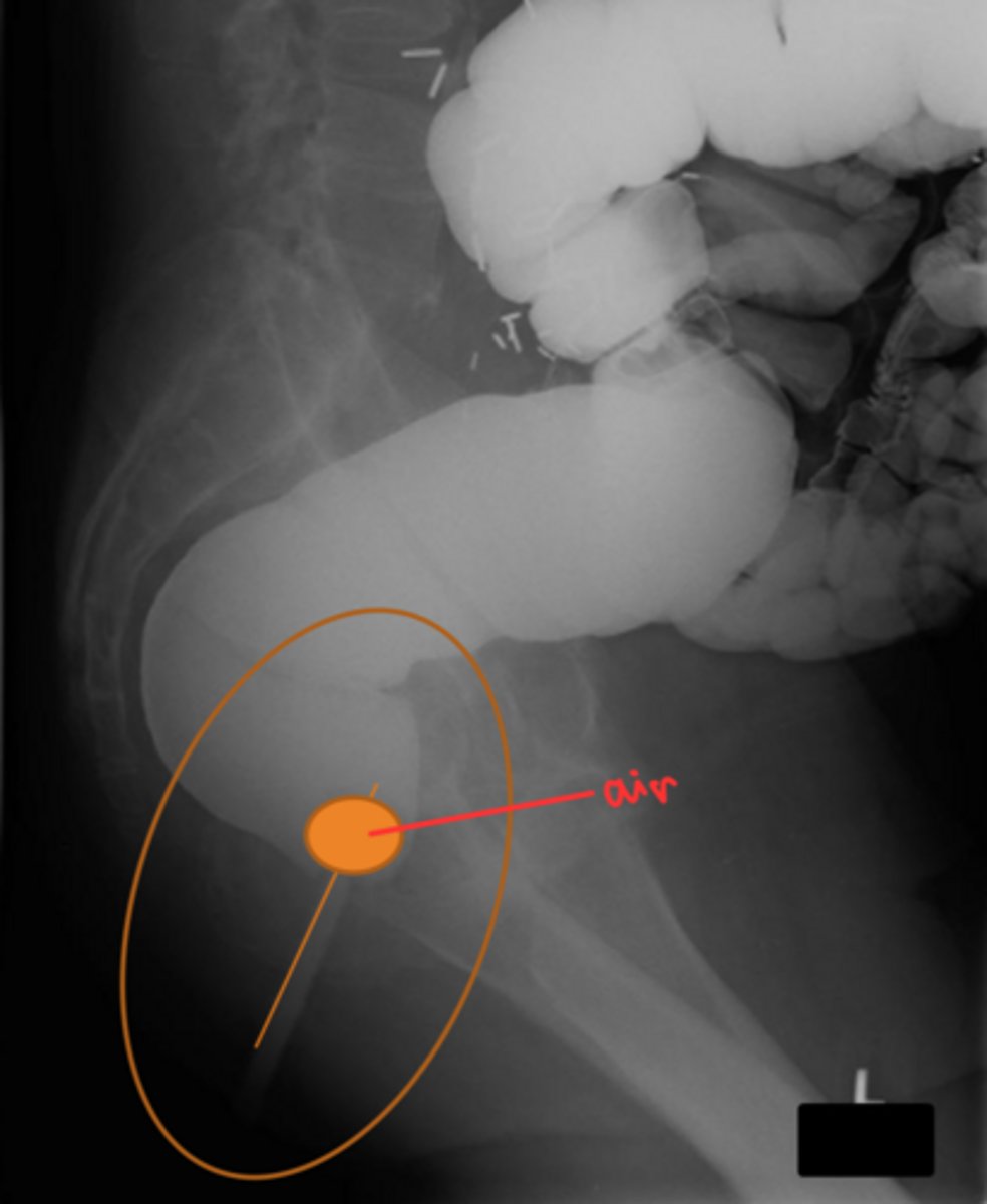 <p>straight or cuffed</p><p>some are triple lumen</p>