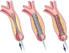 <p>động mạch bị tắc a blocked artery can cause a heart attack</p>