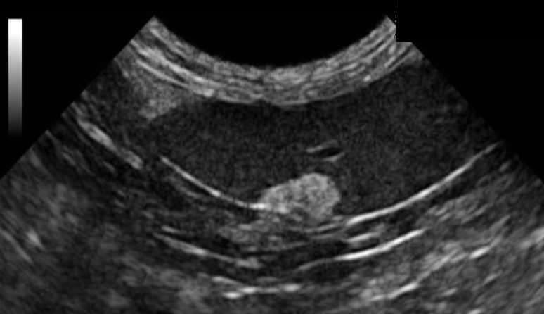 <p>what is occurring in the following ultrasound?</p>