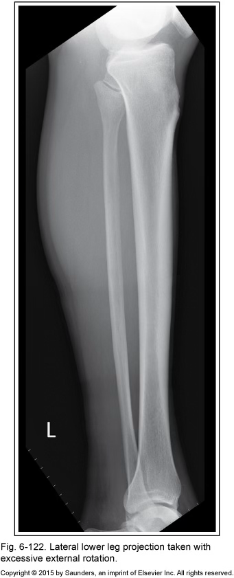 <p>lateral tib fib</p>