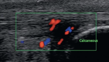 <ul><li><p>inflammation of the tendon</p></li><li><p>S/S: pain, swelling</p></li><li><p>SONO: </p><ul><li><p><span style="color: yellow;">thickened and hypoechoic</span> tendon (diffuse) or enlarged hypoechoic area within tendon (local)</p></li><li><p>possible <span style="color: yellow;">hyperechoic</span> flow within the tendon</p></li></ul></li></ul><p></p>