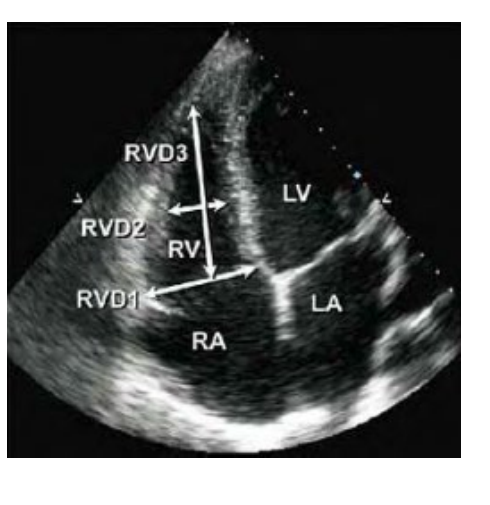 <p>Obtained from an Apical 4 chamber view at end diastole. </p><p>Base diameter is made in the RV near the TV insertion inner edge to inner edge </p><p>Mid cavity diameter is made at the level of papillary muscles inner edge to inner edge </p><p>Abnormal Diameter is > 4.1 cm at the base and </p><p>> 3.5 cm at the mid level </p><p>(indicates RV dilatation) </p><p>Abnormal longitudinal dimension is > 8.3 cm</p>